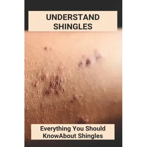 Understand Shingles: Everything You Should Know About Shingles: Shingles Topical Treatment