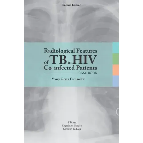 Radiological features of TB in HIV Co-infected Patients. Case book