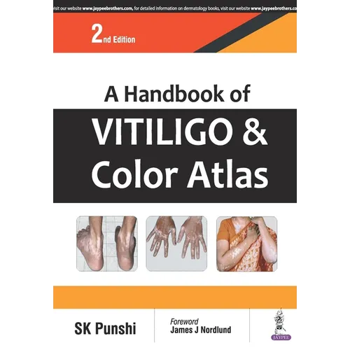A Handbook of Vitiligo and Color Atlas
