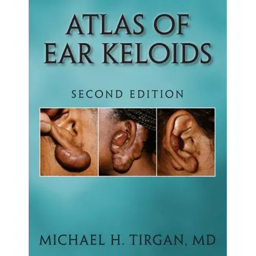 Atlas of Ear Keloids - Second Edition