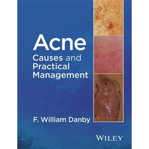 Acne: Causes and Practical Management