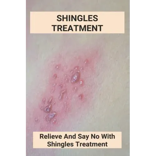 Shingles Treatment: Relieve And Say No With Shingles Treatment: Shingles On Face Treatment - Paperback