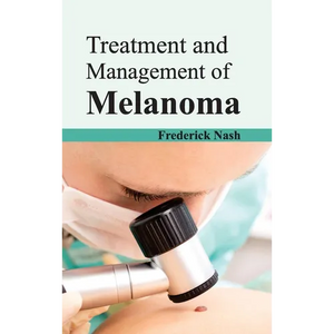 Treatment and Management of Melanoma - Hardcover