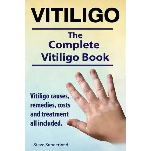 Vitiligo. Vitiligo causes, remedies, costs and treatment all included. The complete Vitiligo Book.